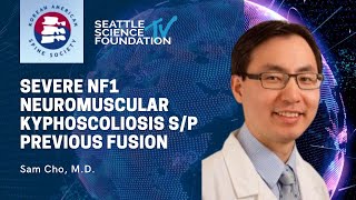 Severe NF1 Neuromuscular Kyphoscoliosis sp Previous Fusion  Sam Cho MD [upl. by Dulcie]