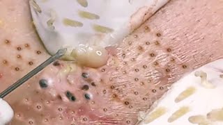 NEW Pimple Popping Compilation  Blackheads removal  Pimple removal vids of 2021 [upl. by Yager]