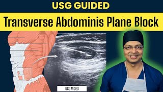 ULTRASOUND GUIDED TAP BLOCKSONOANATOMY and PROCEDURE with real USG VIDEO [upl. by Airlia75]