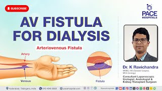 AV Fistula Surgery  AV Fistula for Dialysis  Procedure Uses Benefits amp Complications [upl. by Koren579]