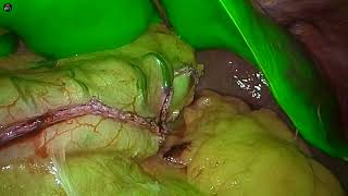 GASTRIC SLEEVE  MORBID OBESITY  WEIGHTLOSS SURGERY by DR AMEYA THAKUR [upl. by Gorrian]