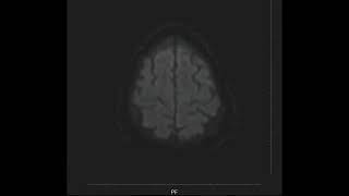 Left Medullary Infarct MRI [upl. by Kin475]