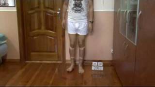 Bow legs correction treatment  China patient experience [upl. by Derrik175]