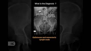 Gallstones and mesenteric lymph node Abdominal Xray Abnormal calcification53radiologychannel007 [upl. by Yssep]