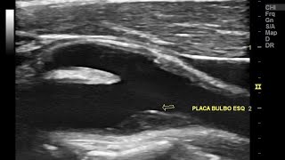 Indicações do Duplex Scan das Carótidas e quem pode fazer Escleroterapia com espuma [upl. by Kate554]