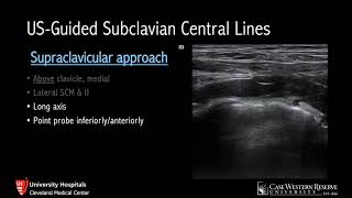 UltrasoundGuided Subclavian Lines [upl. by Oir642]