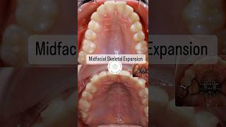 Midfacial Skeletal Expansion MSE before and after [upl. by Cilegna]