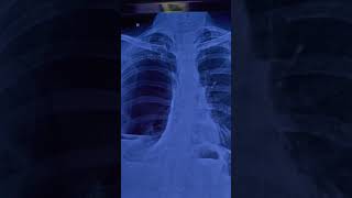 Hydropneumothorax  Chest Xray  Opacifiaction Pleural Effusion  Air fluid levels  Collapse lung [upl. by Ailema]