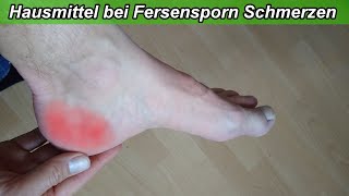 Fersensporn Hausmittel helfen den Schmerz zu lindern  Bei Fersenspor Schmerzen Essig amp Backpulver [upl. by Eninahpets]