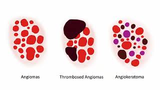 Angiomas and variants  Dr C Navarrete Dechent [upl. by Terrence]