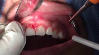 Periotip Nivelacion de margenes gingivales en alargamiento de corona [upl. by Eralc]