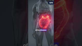 Inflammatory Bowel Disease IBD [upl. by Coussoule]