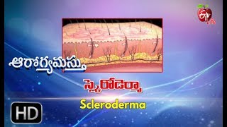 Aarogyamastu  Scleroderma  29th June 2017  ఆరోగ్యమస్తు [upl. by Elahcim]