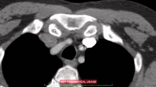 Mediastinal Cross Sectional Anatomy on CT DISCUSSION by Radiologist [upl. by Novick875]