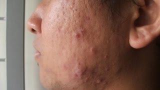 WHAT FOODS CAUSE ACNE [upl. by Japheth]