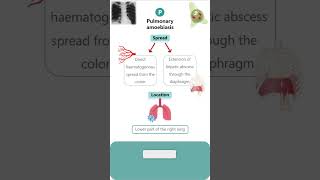 PULMONARY AMOEBIASIS parasitology microbiology pathology neet neetpg amoebiasis amoeba [upl. by Dyane955]