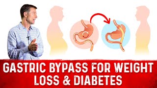 The Reason Why Gastric Bypass Works for Weight Loss amp Diabetes – Dr Berg [upl. by Denyse457]