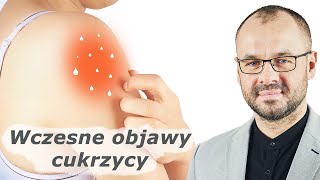 Nie ignoruj ​​tych 10 wczesnych objawów cukrzycy [upl. by Onailil552]