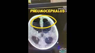 Communicating hydrocephalus  EVD drain  Ventriculitis  Pneumocephalus  Tuberculosis meningitis [upl. by Alisa578]