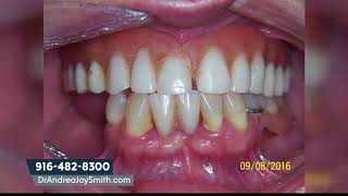 How Much are Mini Dental Implants [upl. by Shaper]