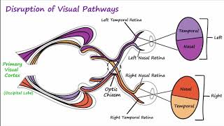 Visual Neural Pathways and Visual Field Defects [upl. by Bertero588]