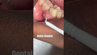 DENTAL ABSCESS abscess dental viraltrending video shorts youtubeshorts fashion fyp po [upl. by Eidurt]