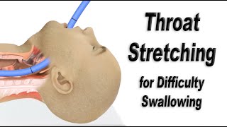 Esophageal Dilation or Throat Stretching for Difficulty Swallowing [upl. by Inga207]