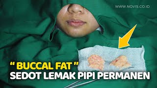 Buang Lemak Pipi Permanen Buccal Fat Removal Mengecilkan Pipi Tembem  NOVIS Dermatology [upl. by Di]