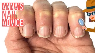 RIDGY NAILS THE COSMETIC SOLUTION ANNAS NAIL ADVICE [upl. by Arihsan]