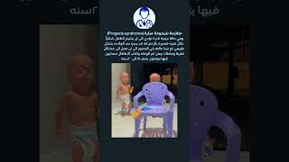 متلازمة الشيوخة المبكرةProgeria syndrome دكتورسيرجن [upl. by Aerdnna]