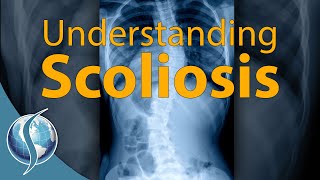 Understanding Scoliosis [upl. by Javier]