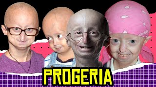 Weird Health News Progeria [upl. by Ennairek543]