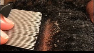 Dandruff Scratching Using Lice Comb [upl. by Minica]