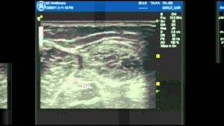 Ultrasound Guided ankle block part 1 [upl. by Leirum104]