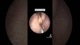 Another super satisfying sinus cleaning with deep booger removal satisfying medical nose [upl. by Arda]