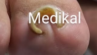 CLİNİQUE PEDİCURE 👣 Medikal Pedikür Tırnak Batması 👣 [upl. by Yerxa]