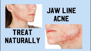 Hormonal acne jawline acne natural treatment of acne [upl. by Enialed]