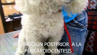 PERICARDIOCENTESIS  CITOLOGIA CON CELULAS NEOPLASICAS [upl. by Attenrad]