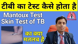 Mantoux test  PPD  Tuberculin Test  Skin Test for TB Diagnosis by Dr Sanjay Chest Specialist [upl. by Landahl]