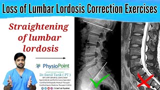 Straightening of lumbar lordosis  loss of lumbar lordosis exercises in hindi  Dr Sunil Tank [upl. by Avivah]