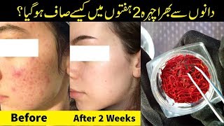 Pimple Acne Crop  Get Rid Fast Permanent Solution Home Remedy Urdu Hindi [upl. by Chaney378]