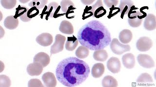 Döhle Bodies present on peripheral blood smear Hematopathology amp Hematology [upl. by Ahern]