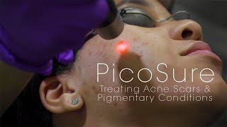 PicoSure Laser for Acne Scars amp Pigmentation [upl. by Eittel918]