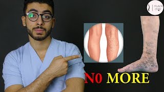 ما هى دوالى الساقين ؟  علاج مشكلة الدوالى نهائيا varicose veins treatment [upl. by Nnov]