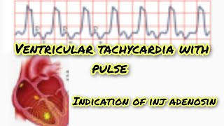 ventricular tachycardia with pulse [upl. by Manbahs]