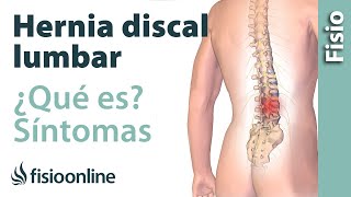 Hernia discal o de disco lumbar  Qué es causas síntomas y tratamiento [upl. by Meeker]