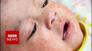 Why is there a measles outbreak in Europe BBC News [upl. by Rehpotsihc501]