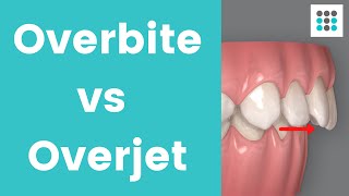 OVERBITE VS OVERJET l Dr Melissa Bailey Orthodontist [upl. by Xirtaeb363]