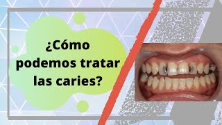 ¿Qué tratamientos hay para las caries  Dr Alvaro Campos [upl. by Alletnahs]