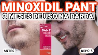 MINOXIDIL PANT  3 MESES DE USO COM FOTOS DE ANTES E DEPOIS NA BARBA  ACHÉ  2024 [upl. by Osnofedli]